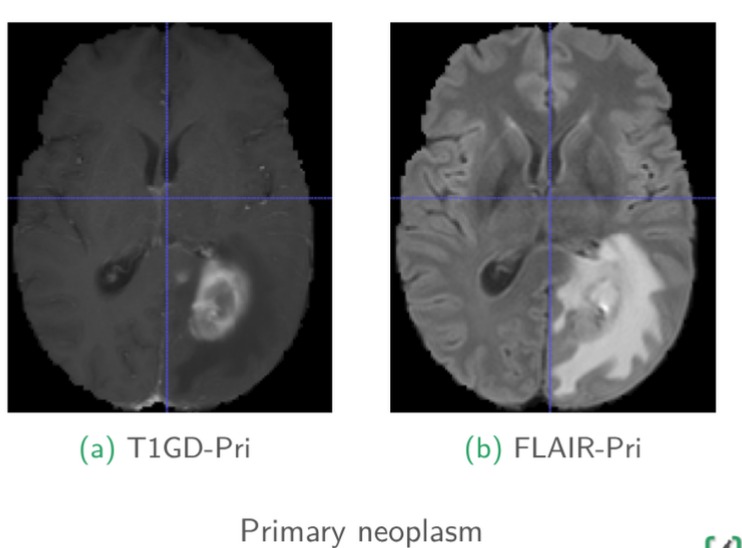 3D Brain MRI Synthesis (Diffusion Models)